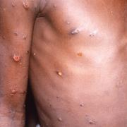 A patient with mpox (PA)